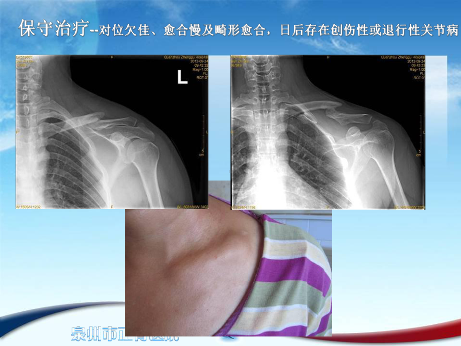 改良闭合穿针治疗锁骨中段骨折疗效分析课件.ppt_第3页