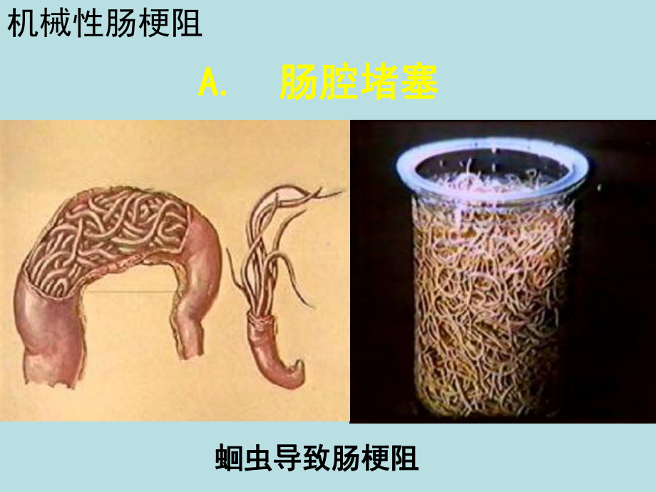 肠梗阻病理知识学习培训模板课件.ppt_第3页