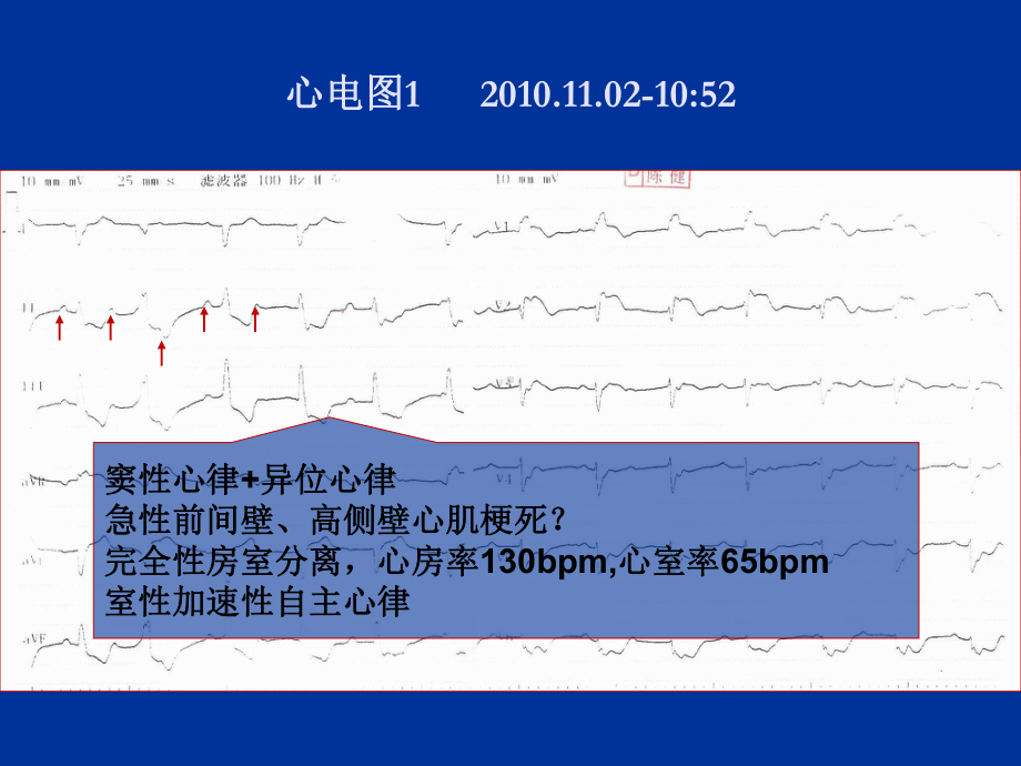 病例讨论胸痛课件.ppt_第3页