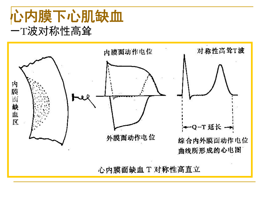 第四次课-心肌缺血、梗塞课件.ppt_第2页