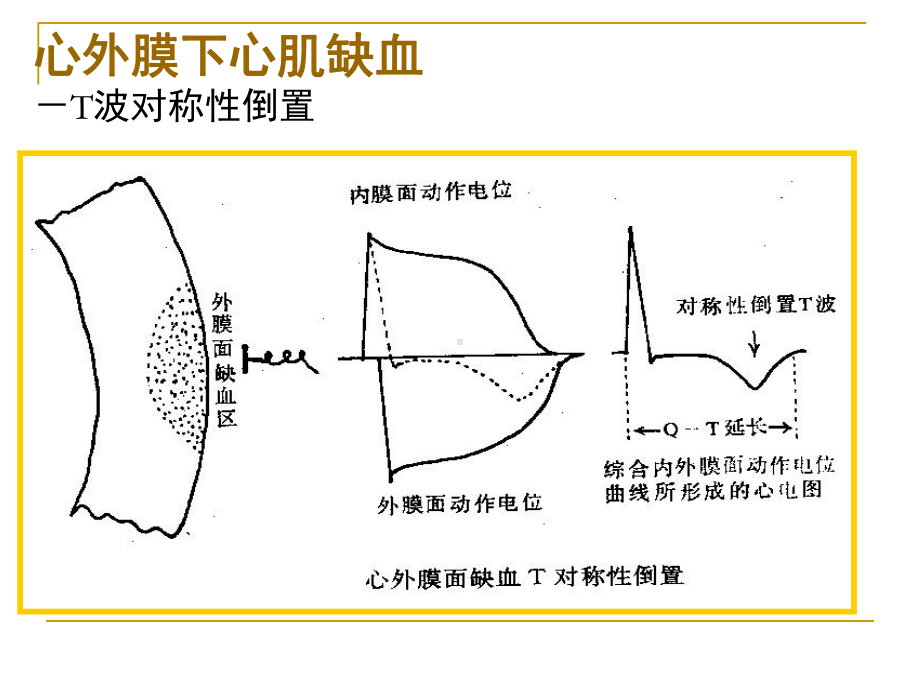 第四次课-心肌缺血、梗塞课件.ppt_第3页