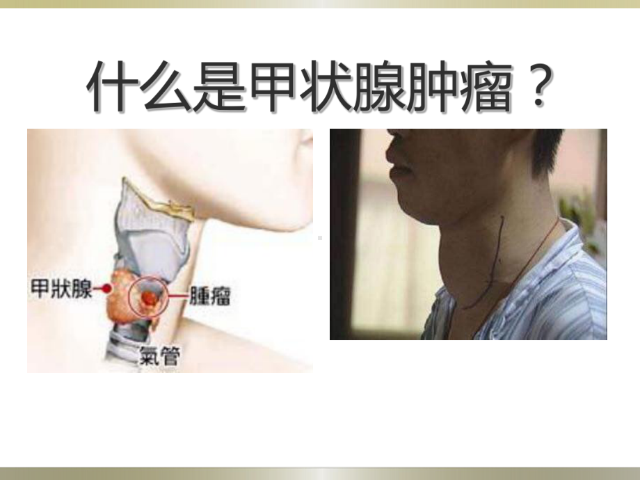 甲状腺疾病知识宣教课件.ppt_第2页