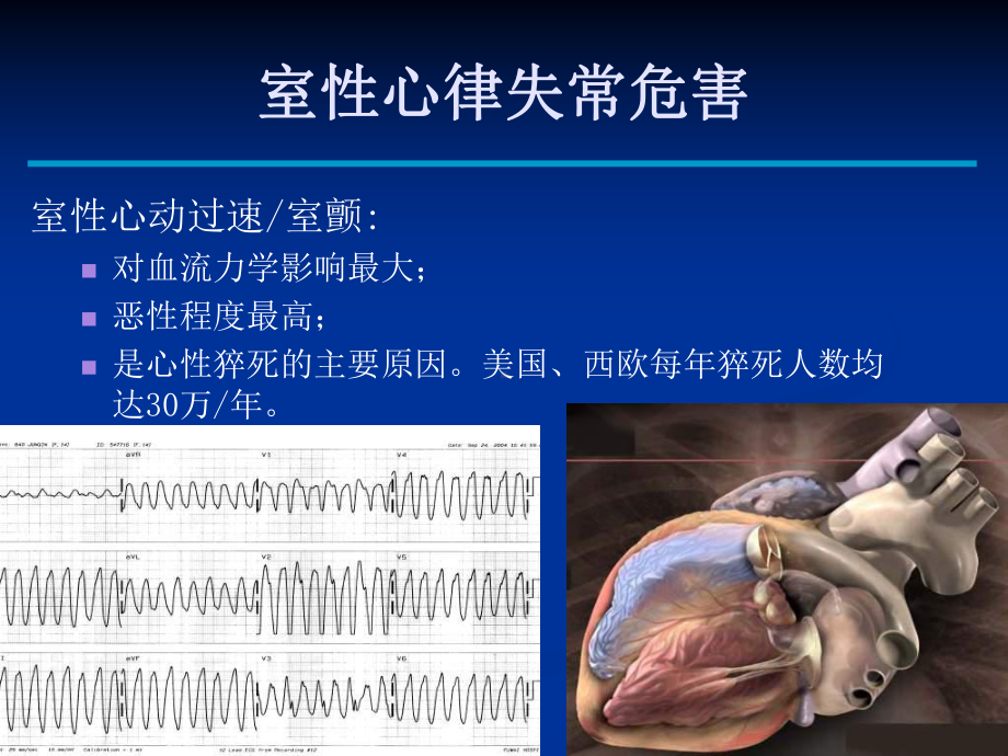 特发性室性心律失常消融治疗进展课件.ppt_第2页