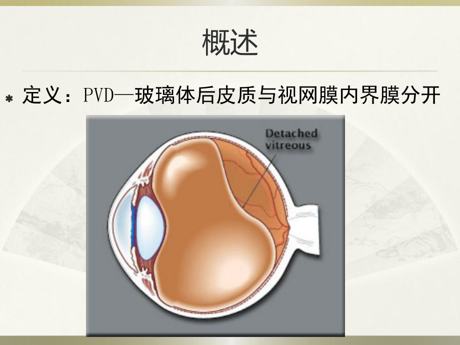 玻璃体后脱离课件.pptx_第3页