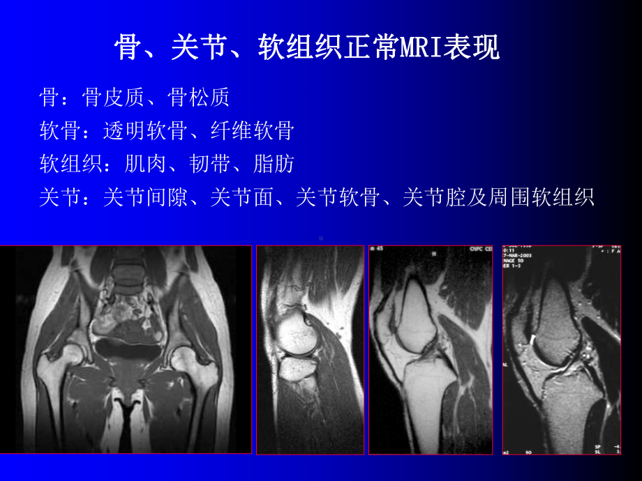 磁共振成像诊断骨、关节及软组织疾病课件.ppt_第3页