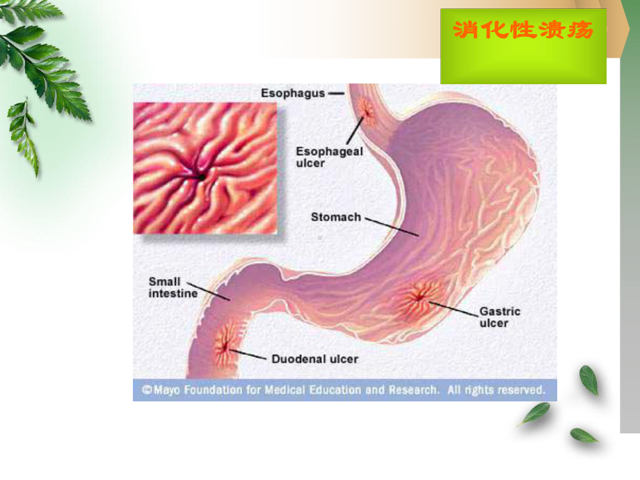 病例消化性溃疡课件.ppt_第2页