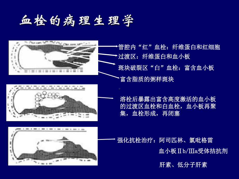 溶栓治疗新进展课件.ppt_第3页