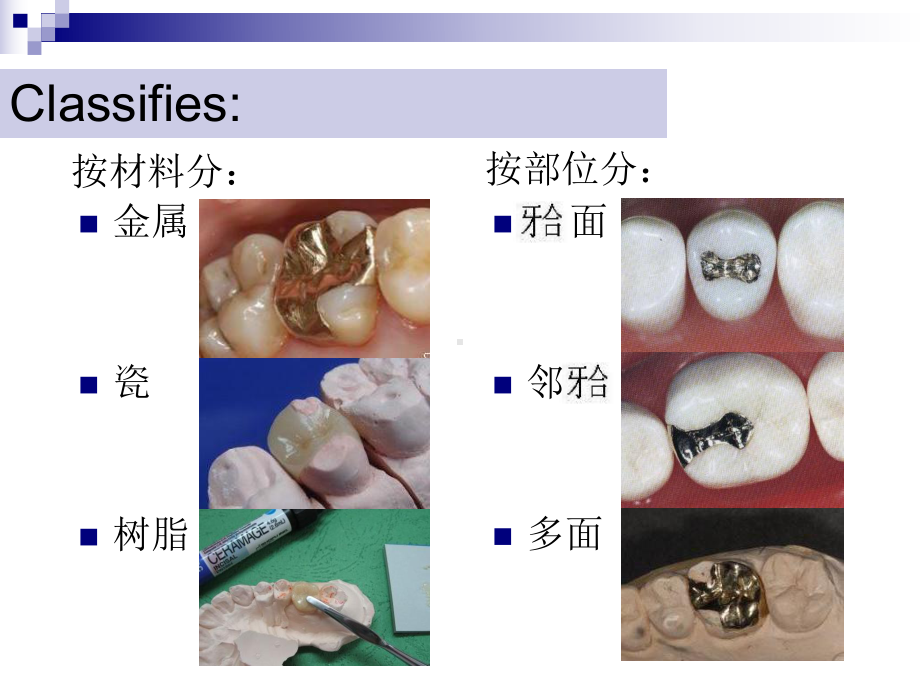 牙体缺损的修复—嵌体课件.ppt_第3页