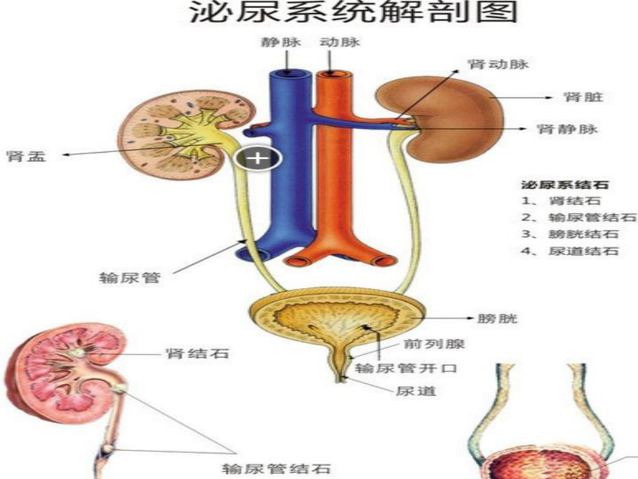 泌尿外科常见疾病的护理1-ppt课件.ppt_第3页