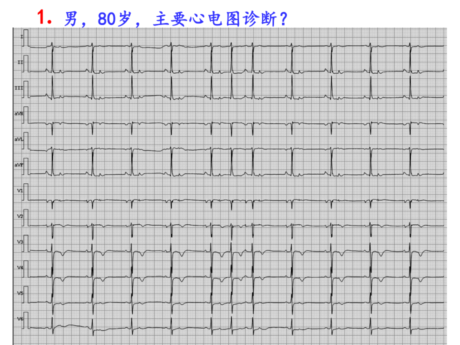 疑难心电图诊断课件.ppt_第2页