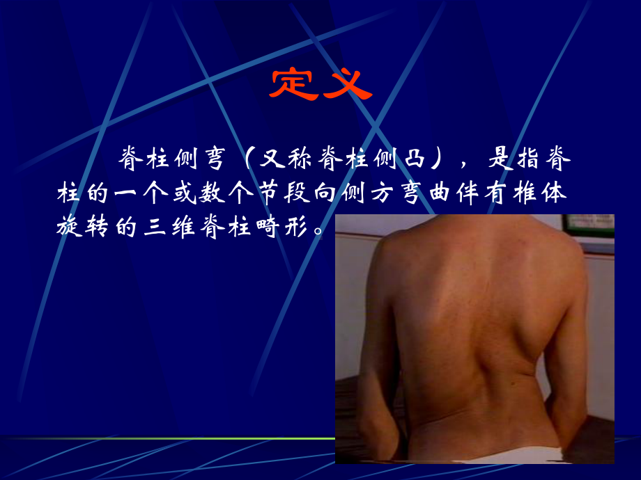 特发性脊柱侧弯评定及康复治疗课件.ppt_第2页