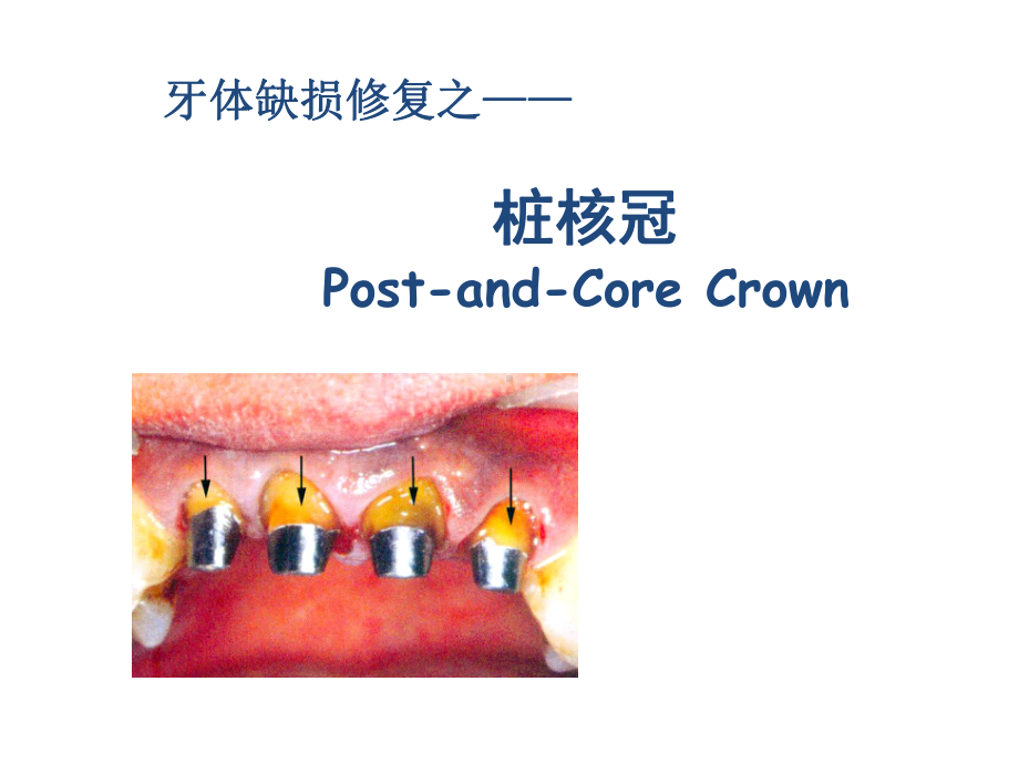 牙体缺损的修复—桩核冠课件.ppt_第1页