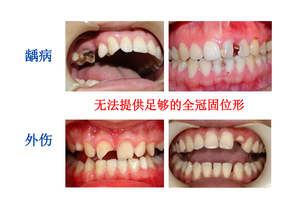 牙体缺损的修复—桩核冠课件.ppt_第2页