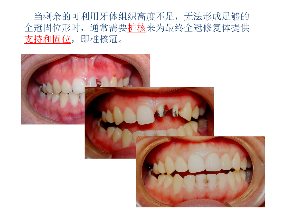 牙体缺损的修复—桩核冠课件.ppt_第3页