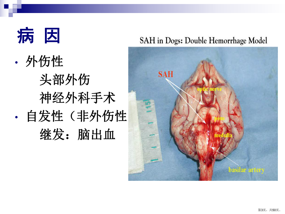 蛛网膜下腔出血SubarachnoidhemorrhageSAH课件.ppt_第3页