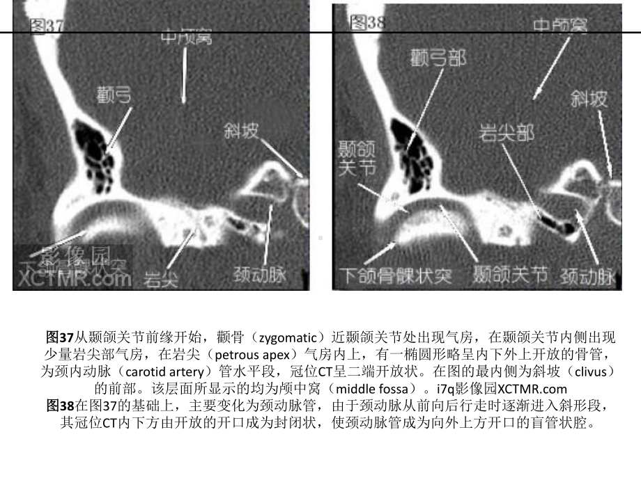 耳部颞骨冠状位HRCT解剖课件.pptx_第2页