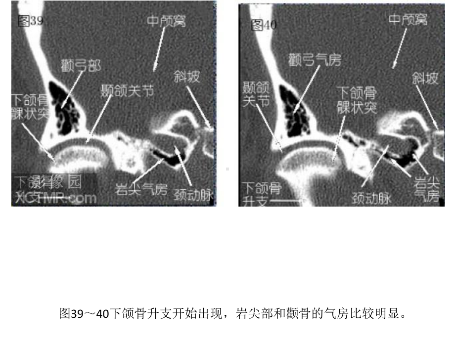 耳部颞骨冠状位HRCT解剖课件.pptx_第3页