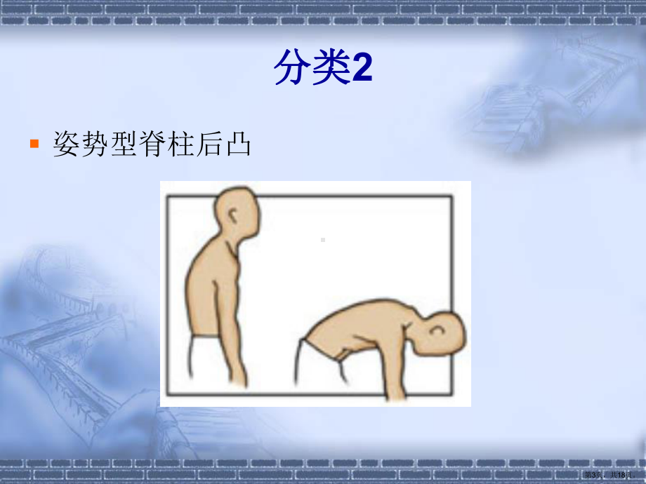 脊柱后凸治疗与护理课件.ppt_第3页