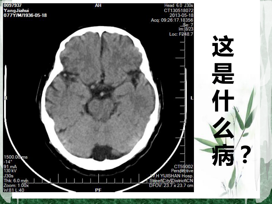 蛛网膜囊肿-PPT课件.ppt_第2页