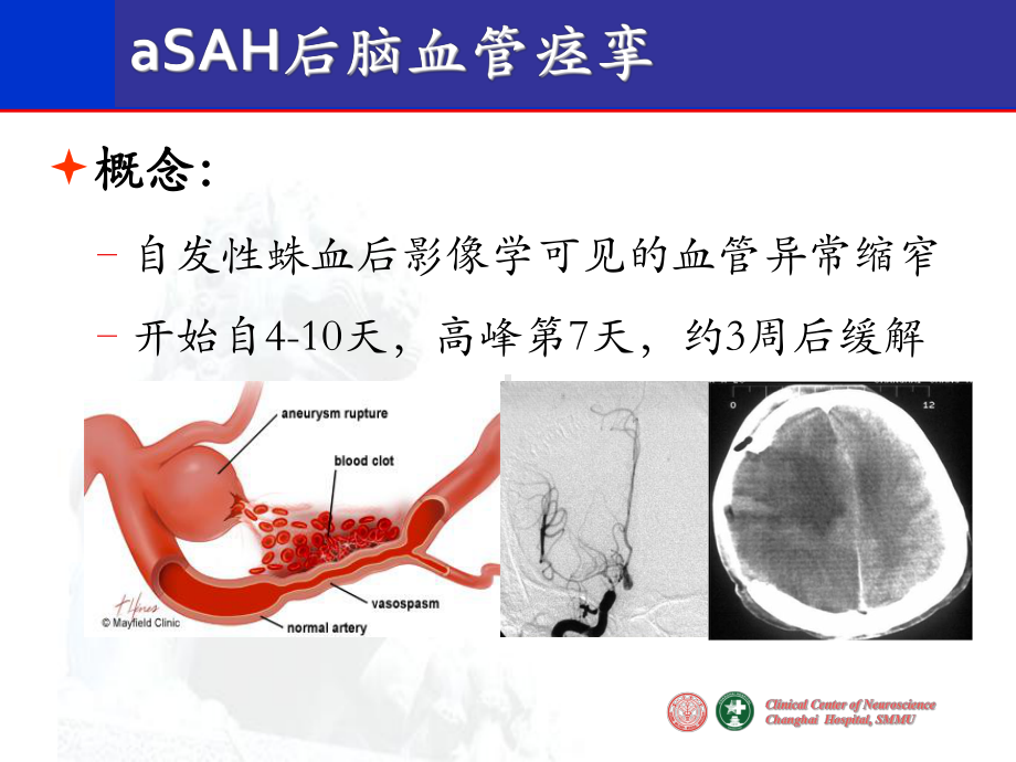 脑血管痉挛的诊疗规范和介入治疗课件.ppt_第2页