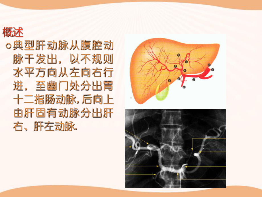 肝癌肝外血供特点及介入治疗课件.ppt_第2页