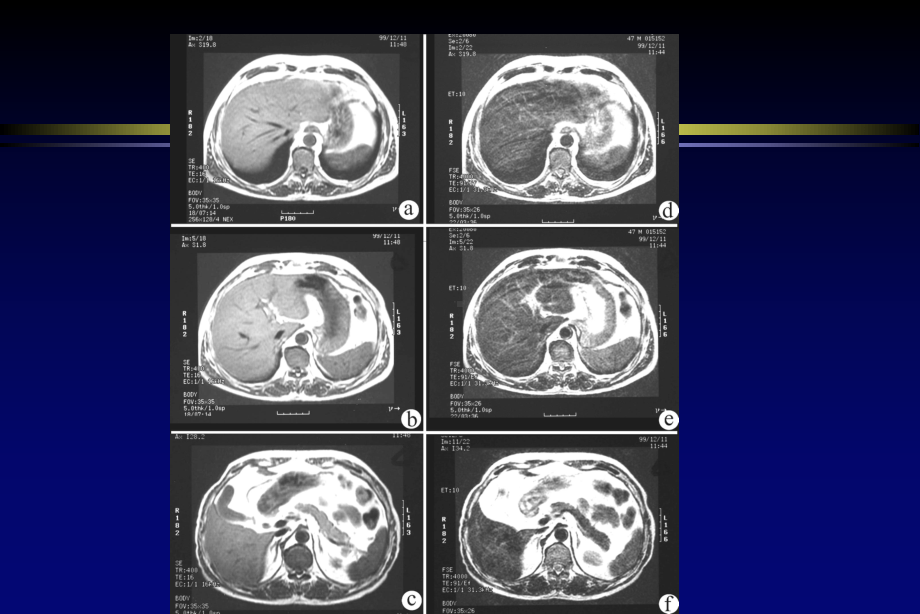 腹盆部影像解剖MR课件.ppt_第3页
