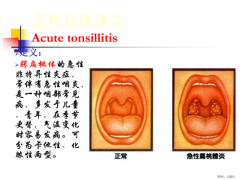 耳鼻咽喉头颈外科学三05扁桃体炎课件.ppt_第3页