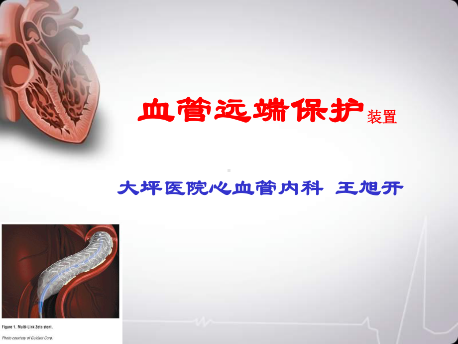 血管远端保护装置课件.ppt_第1页