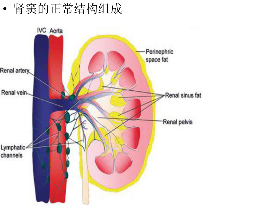 肾窦病变的影像诊断课件.ppt_第3页