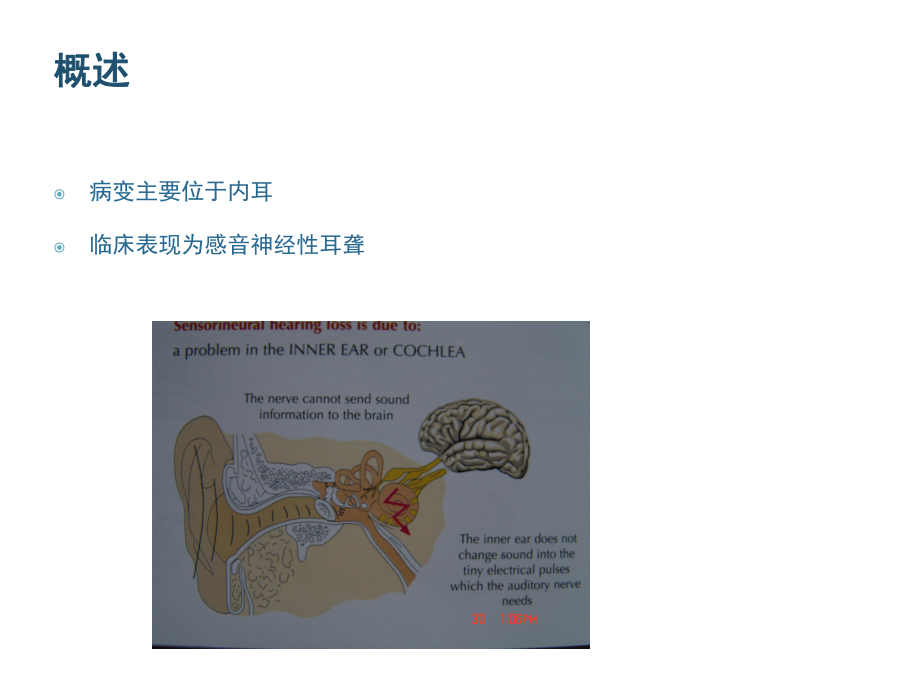 耳鼻喉内耳疾病课件.ppt_第2页