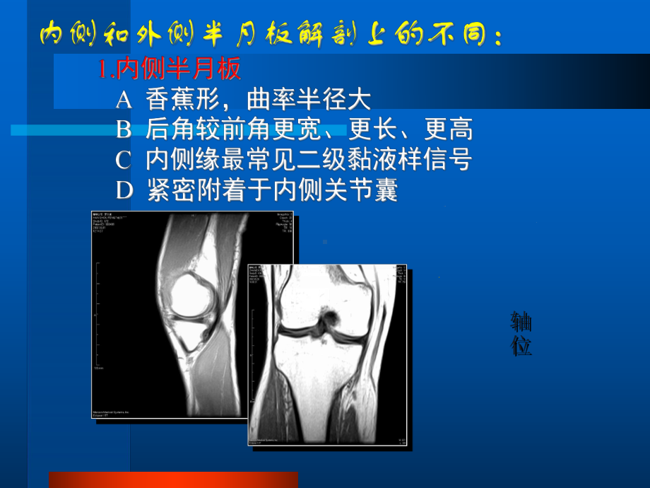 膝关节半月板MRI成像-精品医学课件.ppt_第2页