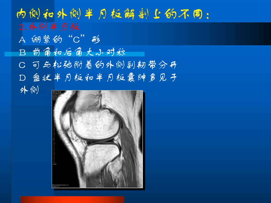 膝关节半月板MRI成像-精品医学课件.ppt_第3页