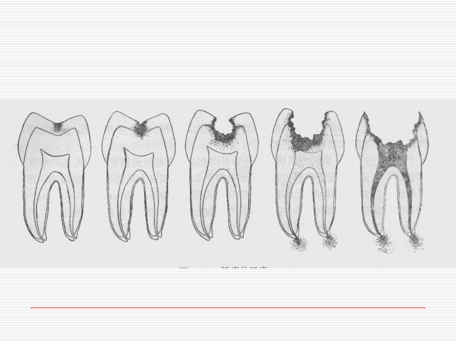 牙体牙髓课件.ppt_第2页