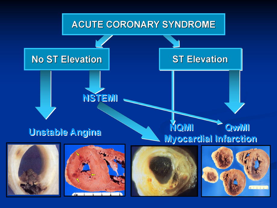 老年急性冠脉综合征的诊治进展课件.ppt_第3页