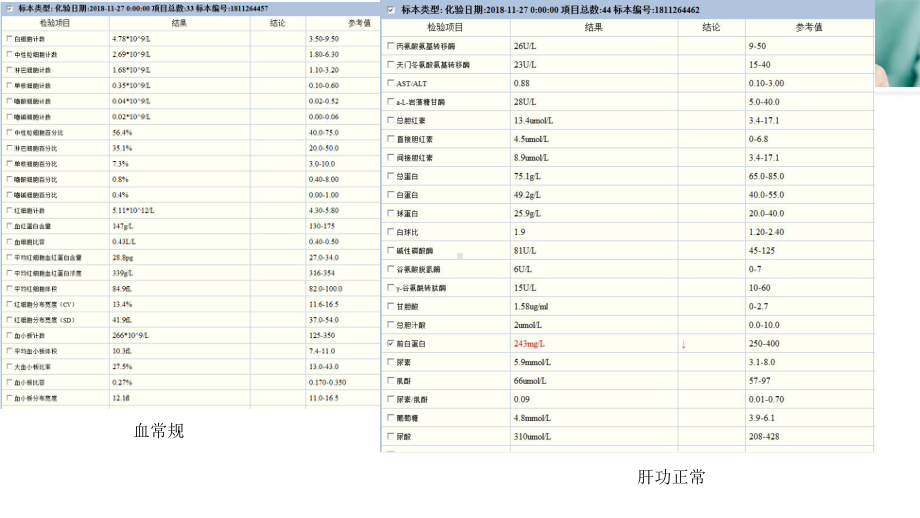 肝脏上皮样血管内皮瘤影像学表现（可编辑的）课件.ppt_第2页