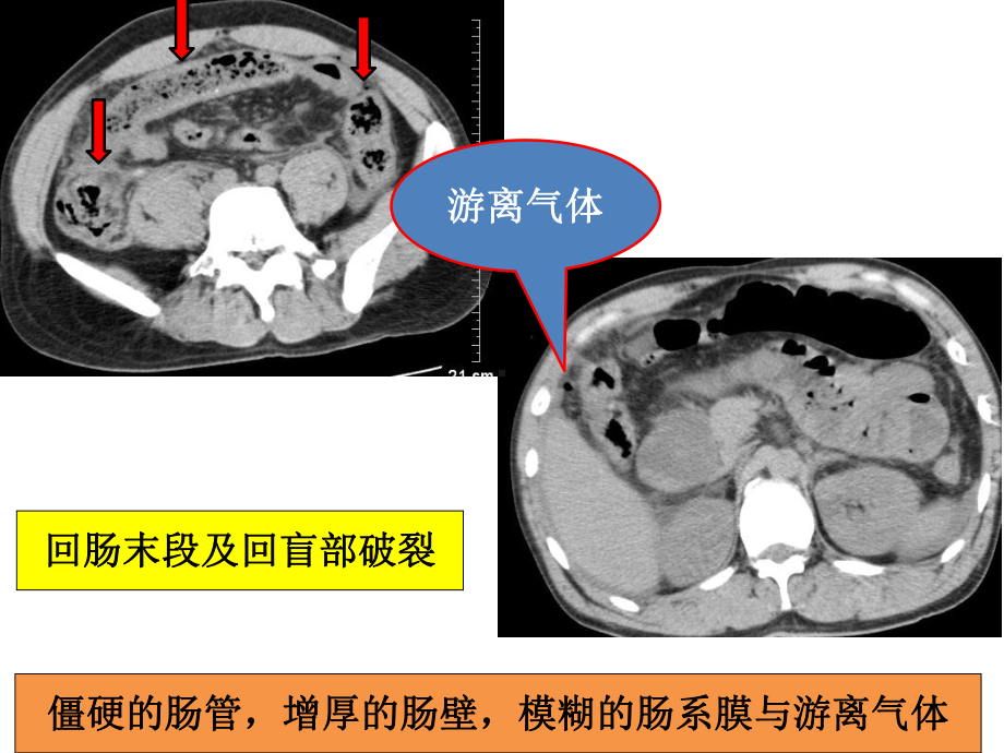 肠管损伤的影像诊断影像FTP课件.ppt_第3页