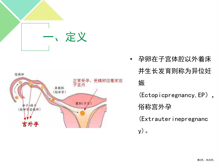 腹腔镜异位妊娠病灶清除术讲解课件.ppt_第2页