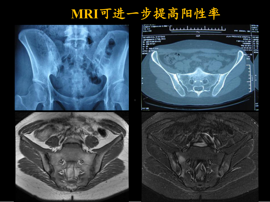 脊柱关节炎MRI读片课件.pptx_第3页