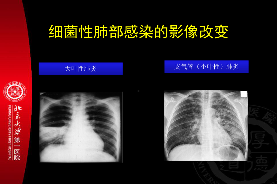 细菌性感染和真菌性感染的影像学差异课件.ppt_第3页