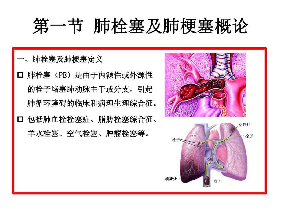 肺栓塞与肺梗塞CT诊断课件.ppt_第2页