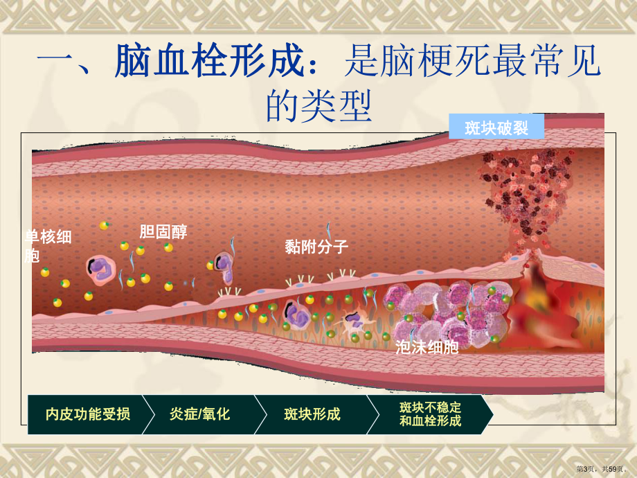 脑梗死诊断、影像学、治疗课件.ppt_第3页