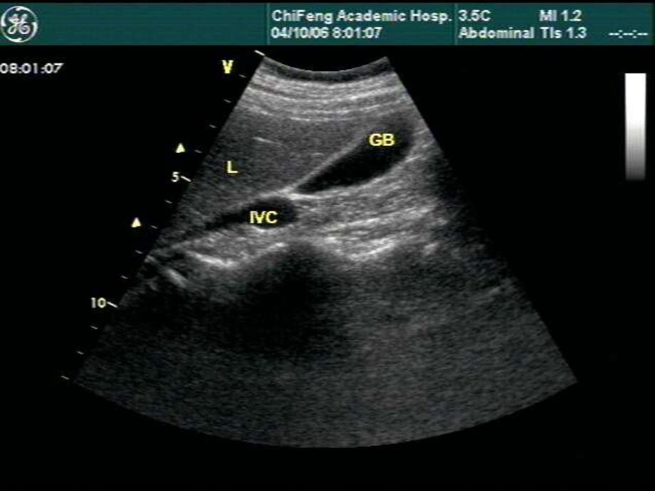 腹部超声诊断学-ppt课件.ppt_第2页