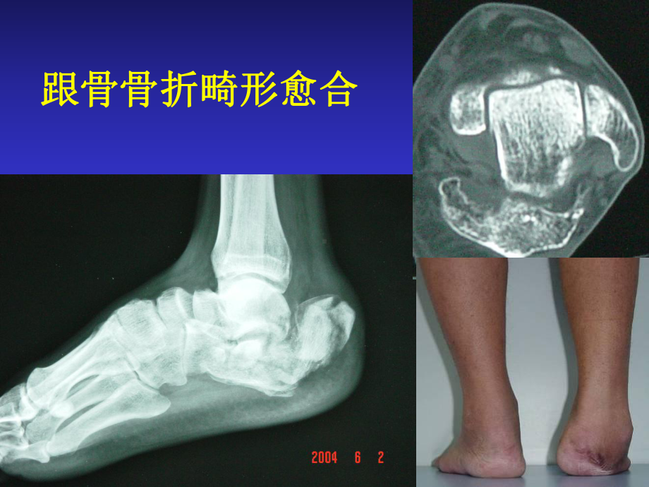 跟骨畸形愈合治疗课件.ppt_第2页