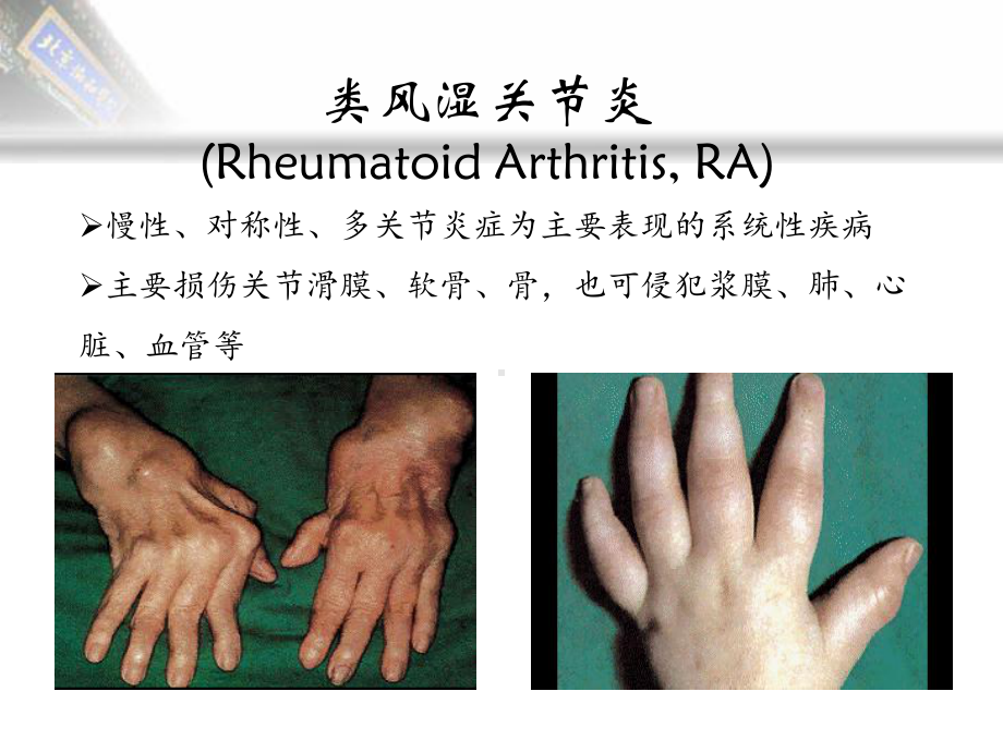 类风湿关节炎自身抗体谱课件.ppt_第2页