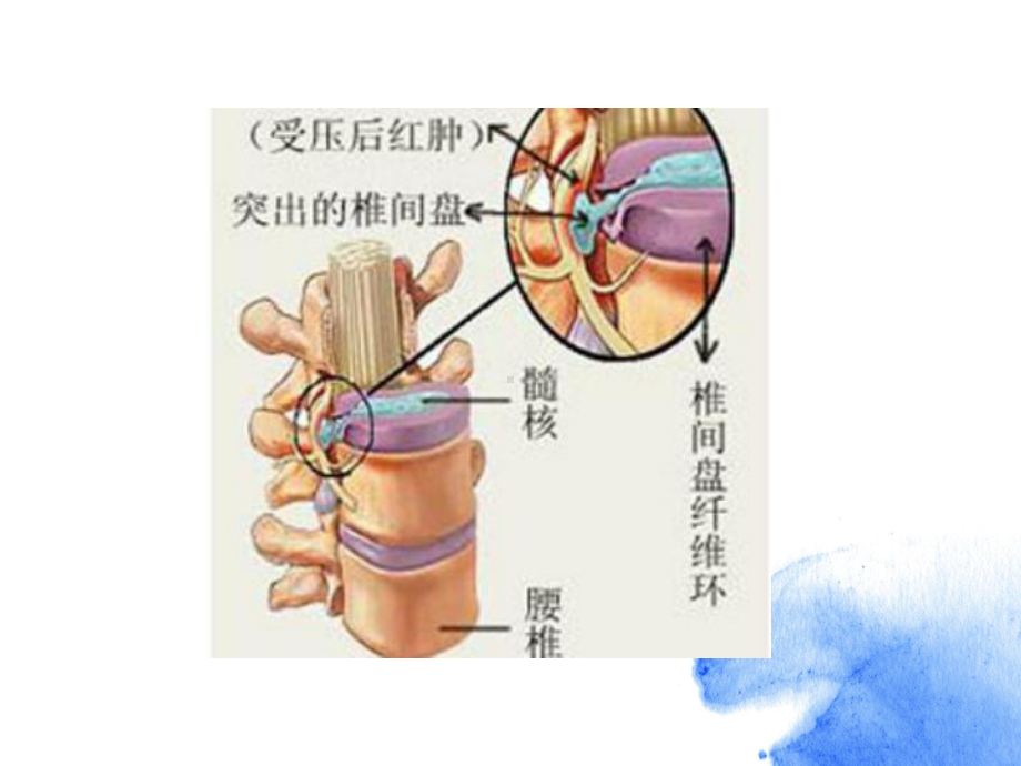 腰椎间盘突出症版本课件.ppt_第3页