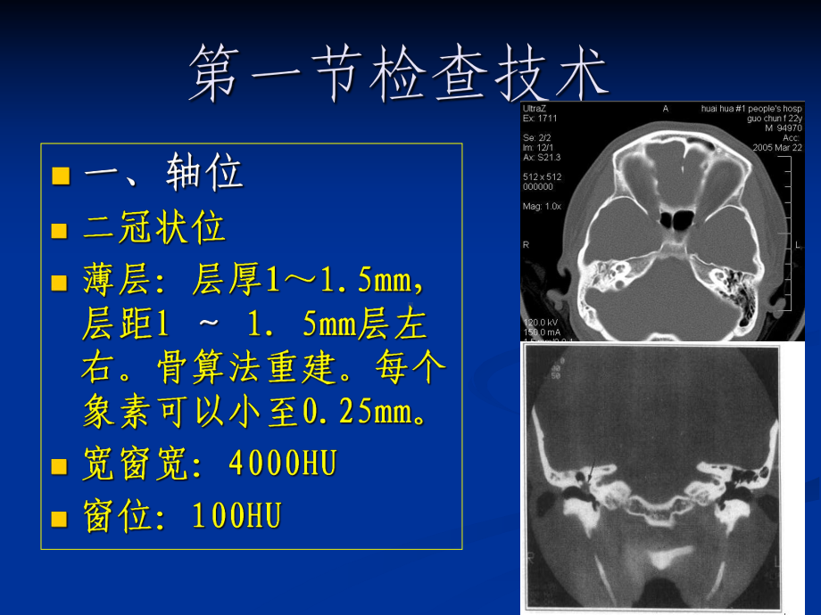 耳颞骨病变的CT诊断鼻窦课件.ppt_第2页