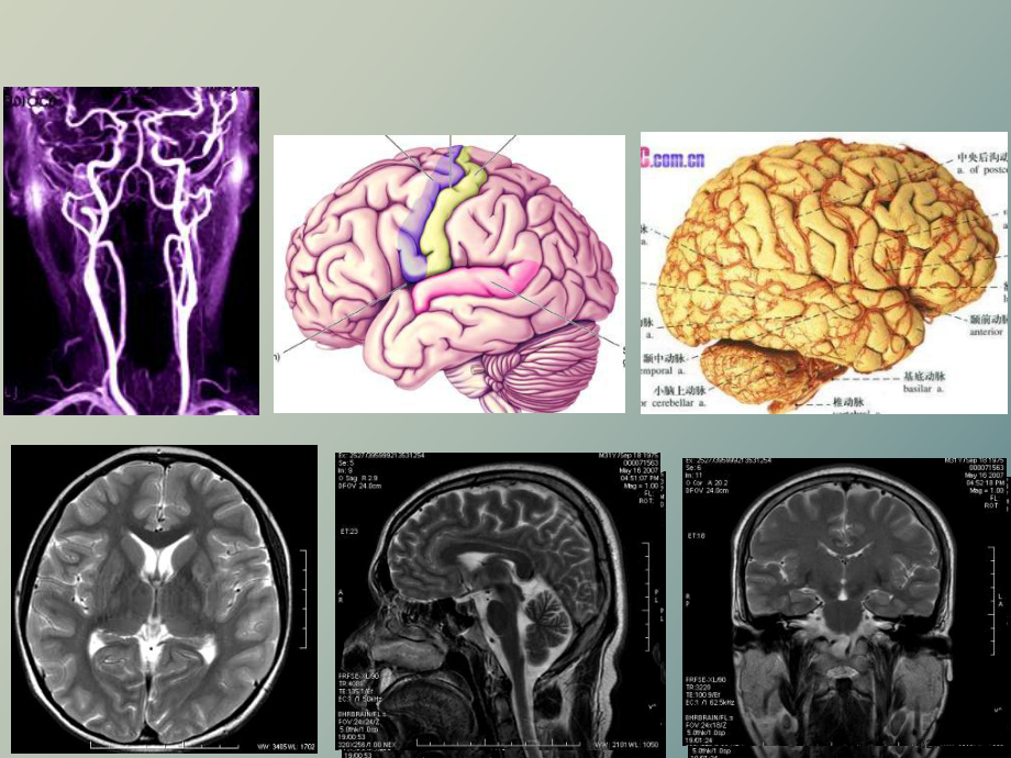 （教学课件）脑血管断层影像解剖.ppt_第2页