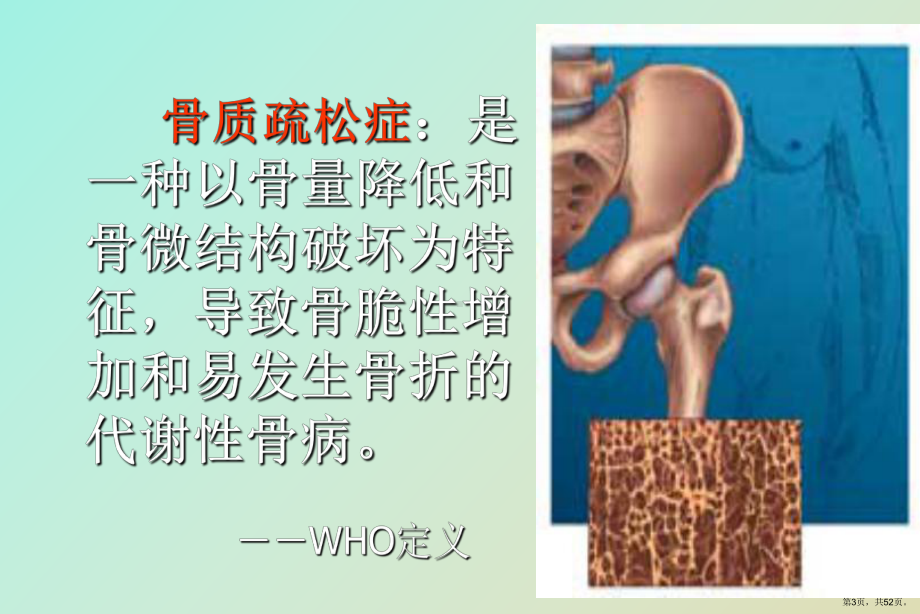 （教学课件）骨质疏松症防治.ppt_第3页