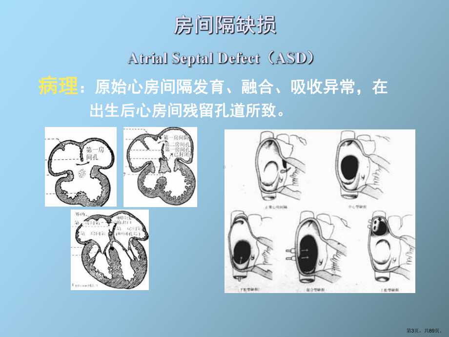 （教学课件）心血管病影像诊断.ppt_第3页