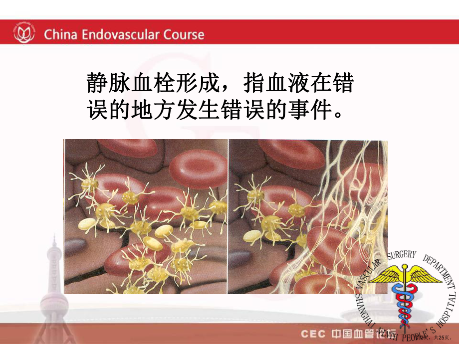 下肢深静脉血栓的治疗教学课件.ppt_第2页